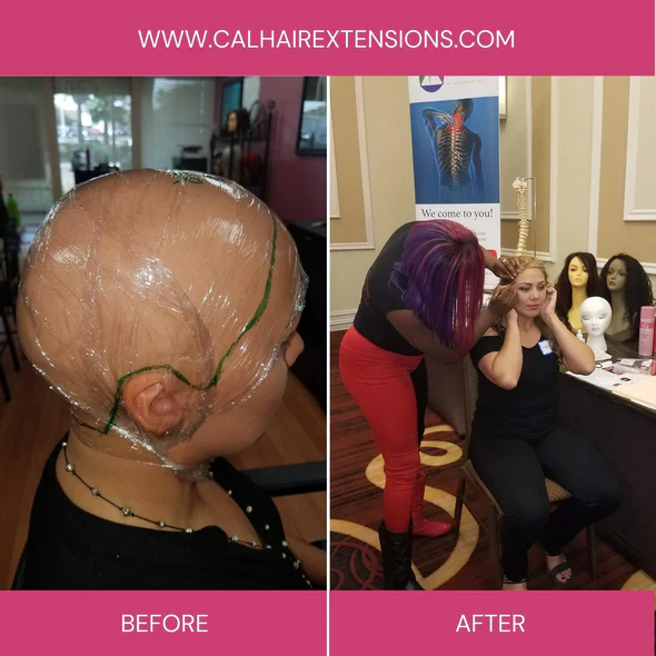 Alopecia Totalis