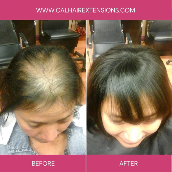 Androgenetic Alopecia