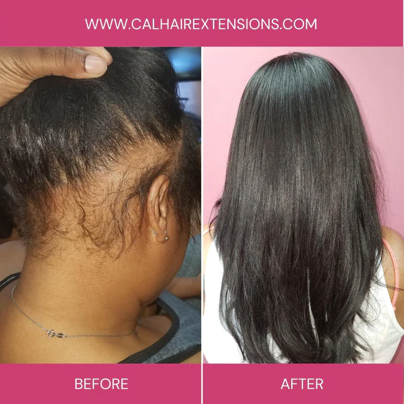 Traction Alopecia